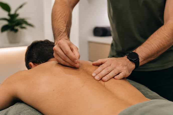 Remedial massage therapist applying dry needling